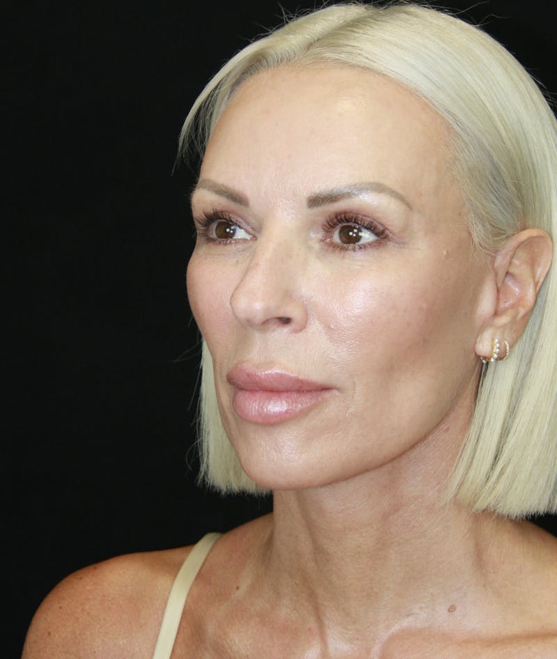 Facelift & Neck Lift Before & After Gallery - Patient 178287179 - Image 6