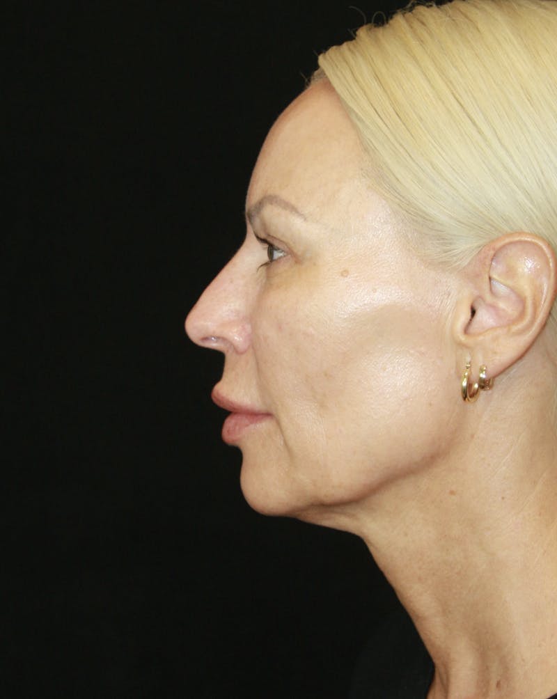 Facelift & Neck Lift Before & After Gallery - Patient 178287179 - Image 7