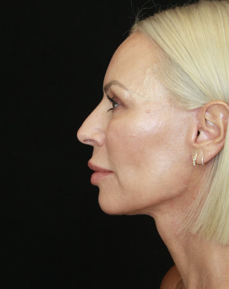 Facelift & Neck Lift Before & After Gallery - Patient 178287179 - Image 8