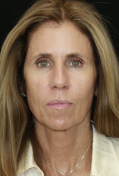 Facelift & Neck Lift Before & After Gallery - Patient 178289387 - Image 1