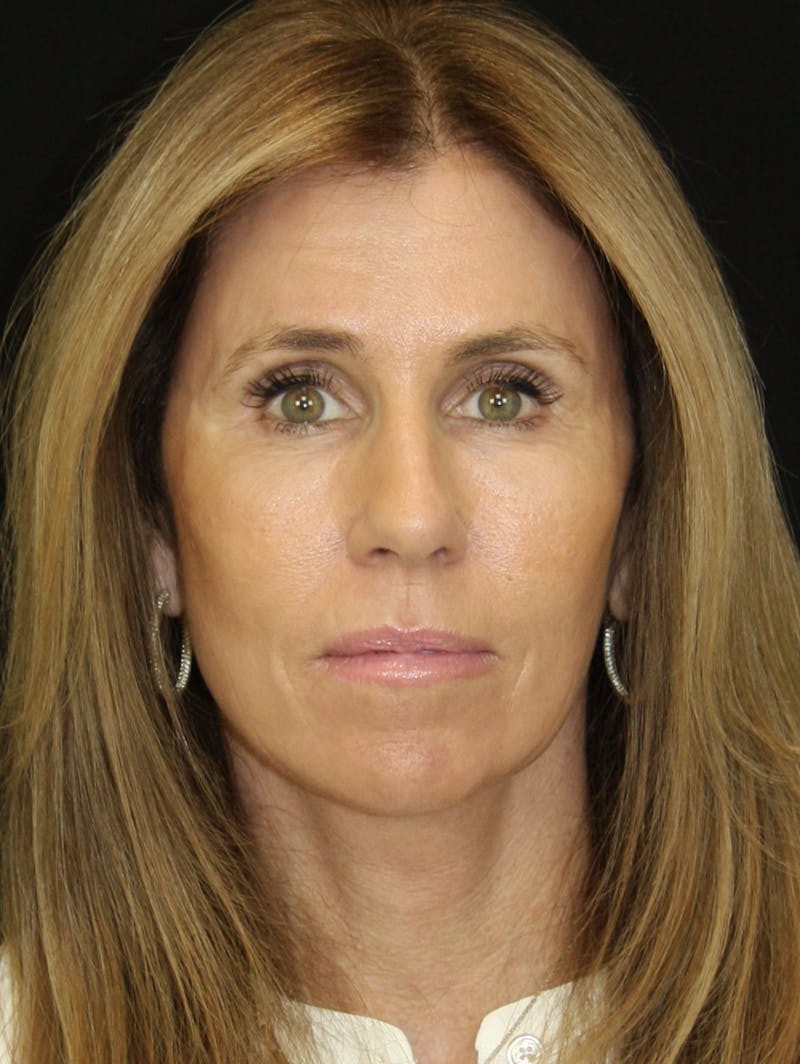 Facelift & Neck Lift Before & After Gallery - Patient 178289387 - Image 2