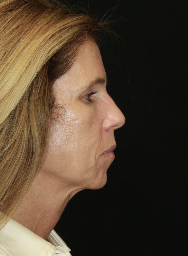 Facelift & Neck Lift Before & After Gallery - Patient 178289387 - Image 5