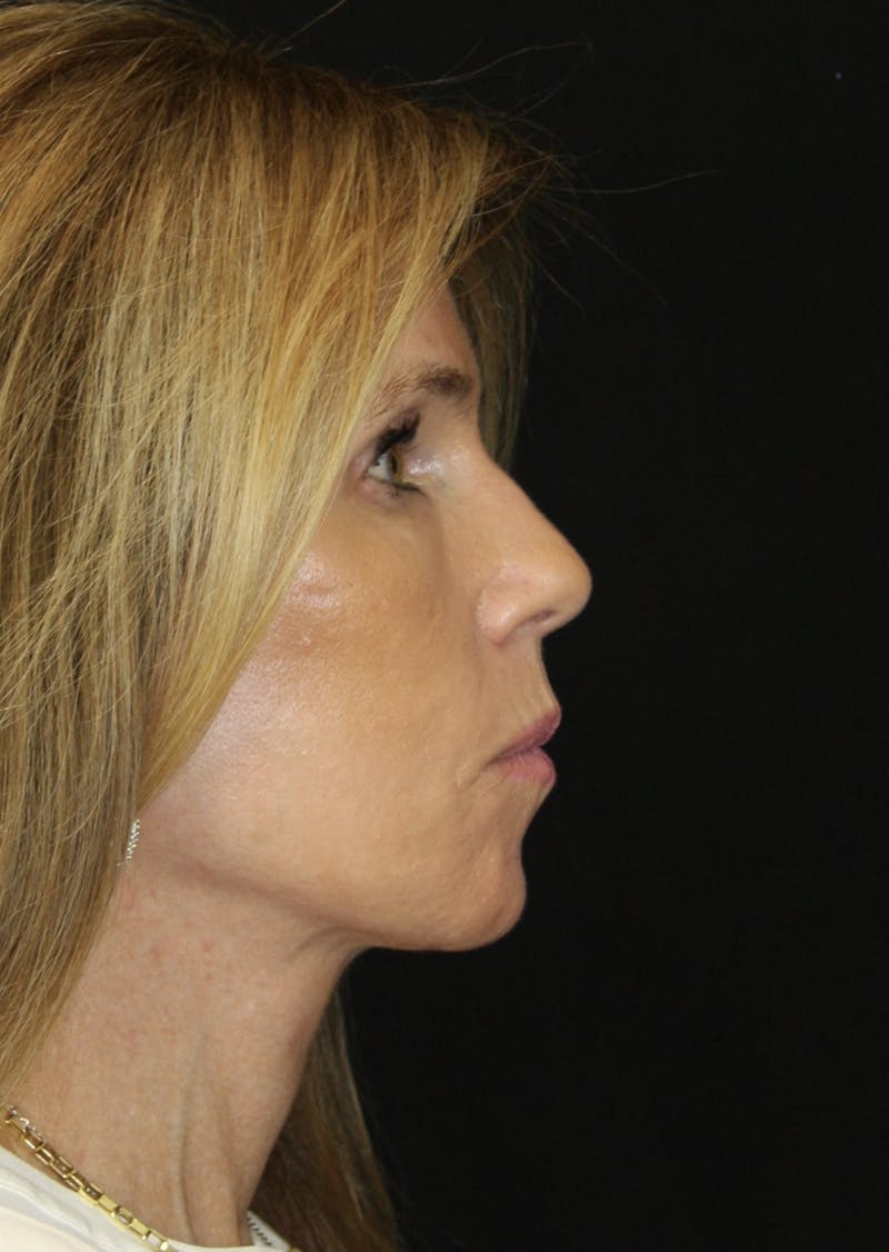 Facelift & Neck Lift Before & After Gallery - Patient 178289387 - Image 6