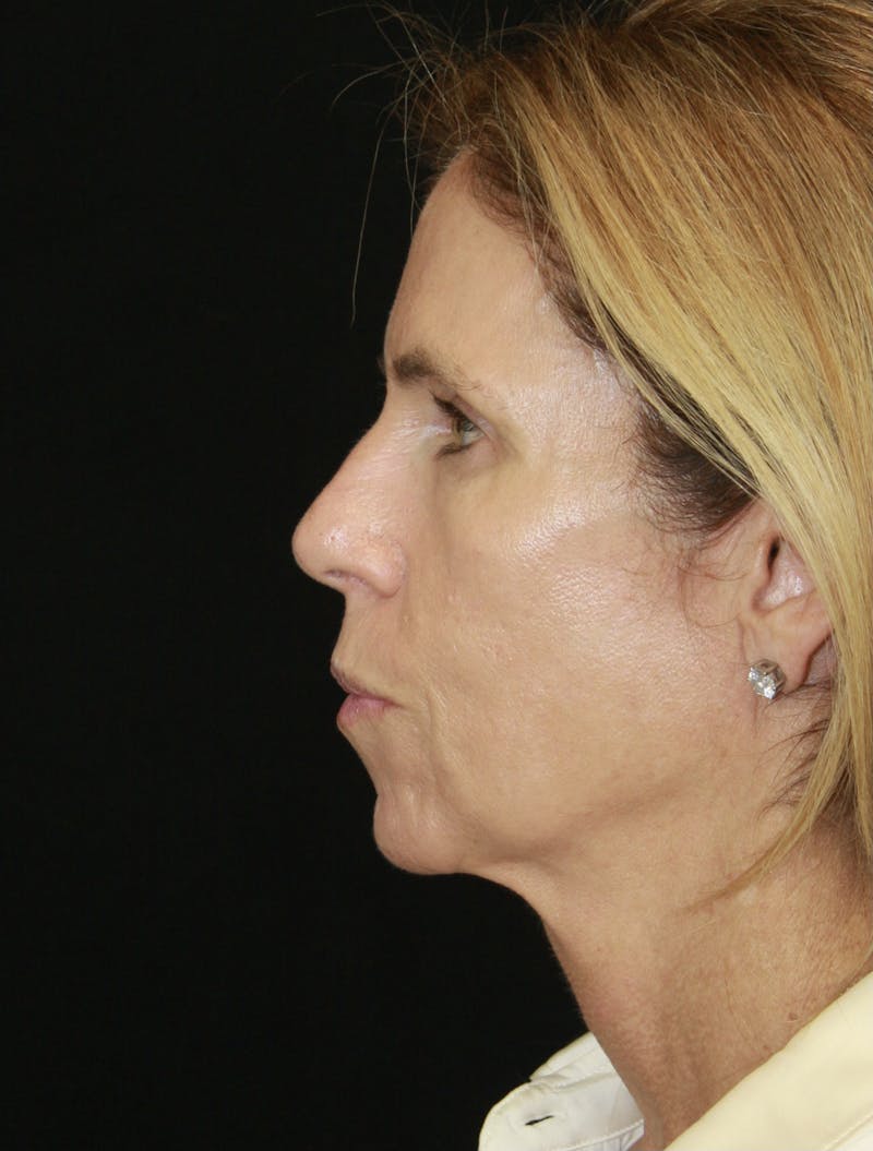 Facelift & Neck Lift Before & After Gallery - Patient 178289387 - Image 9
