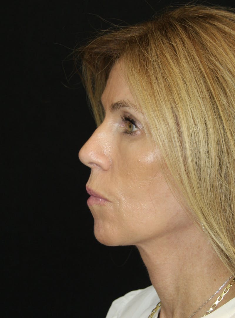 Facelift & Neck Lift Before & After Gallery - Patient 178289387 - Image 10