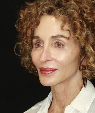 Facelift & Neck Lift Before & After Gallery - Patient 178840008 - Image 2