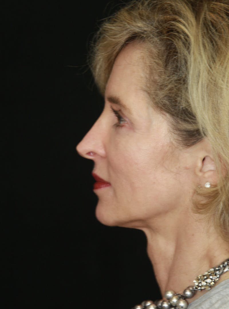 Facelift & Neck Lift Before & After Gallery - Patient 178840008 - Image 3