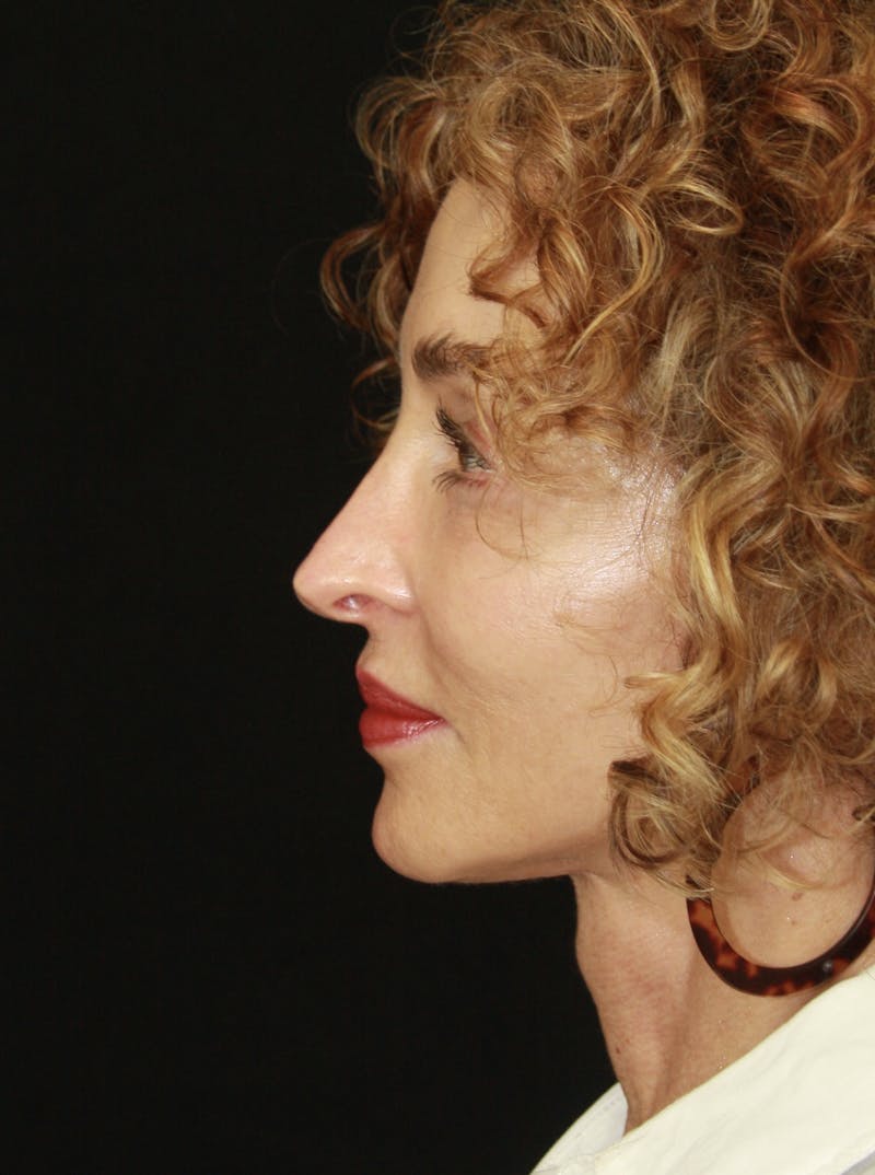 Facelift & Neck Lift Before & After Gallery - Patient 178840008 - Image 4