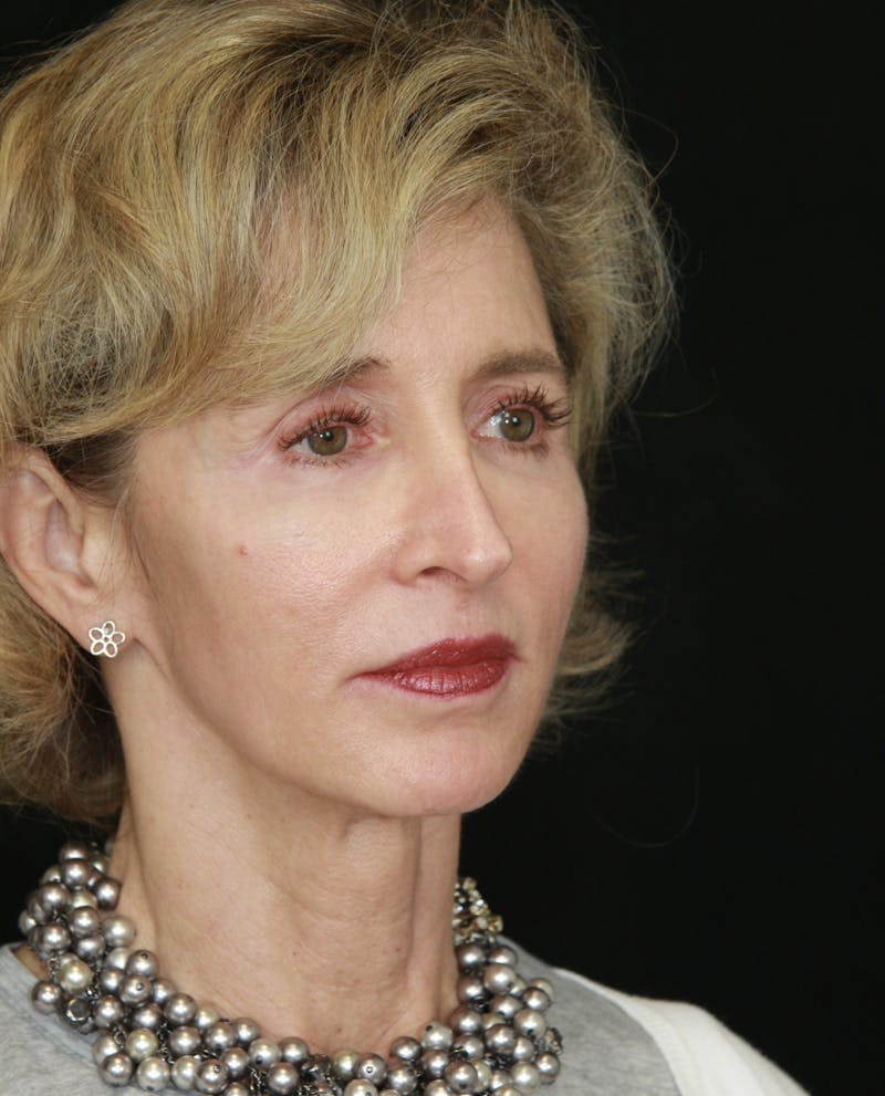 Facelift & Neck Lift Before & After Gallery - Patient 178840008 - Image 5