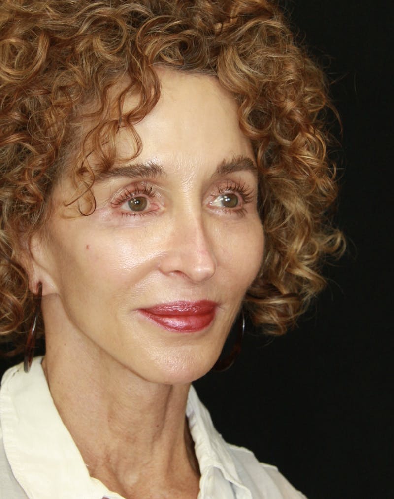 Facelift & Neck Lift Before & After Gallery - Patient 178840008 - Image 6