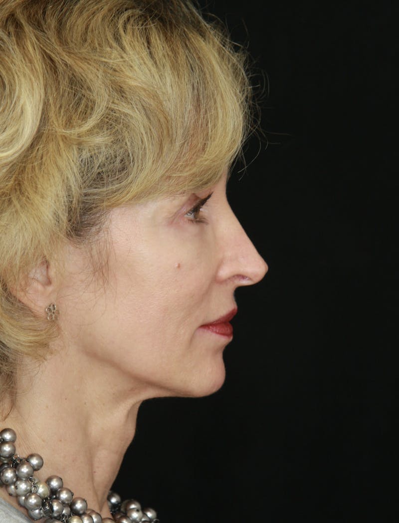 Facelift & Neck Lift Before & After Gallery - Patient 178840008 - Image 7