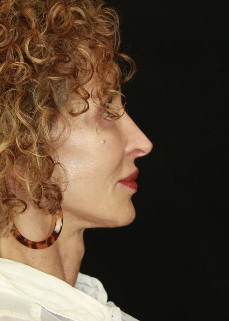 Facelift & Neck Lift Before & After Gallery - Patient 178840008 - Image 8