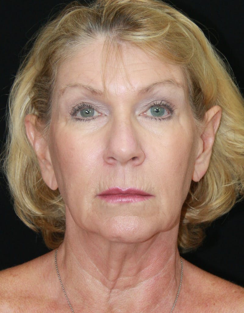 Facelift & Neck Lift Before & After Gallery - Patient 179412013 - Image 1