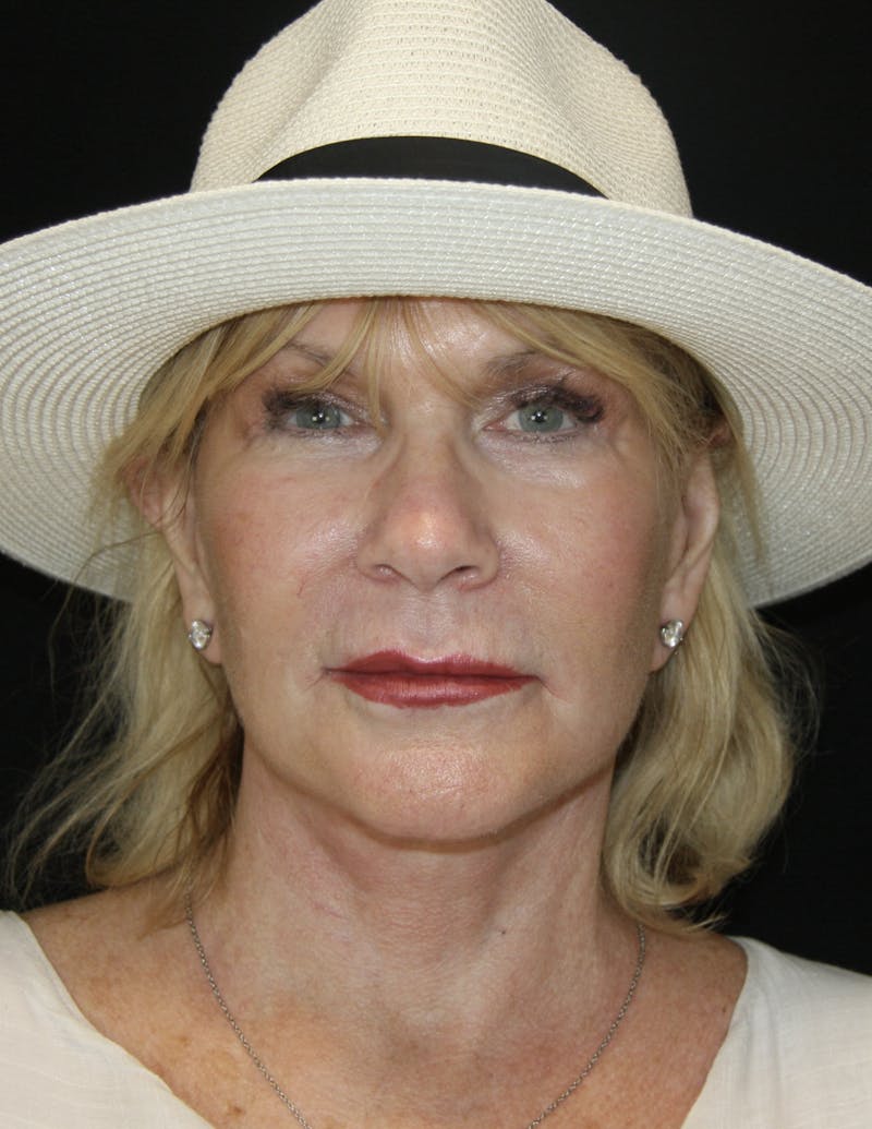 Facelift & Neck Lift Before & After Gallery - Patient 179412013 - Image 2