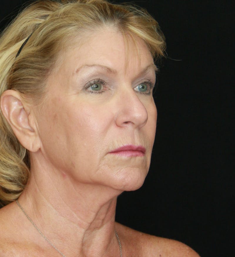 Facelift & Neck Lift Before & After Gallery - Patient 179412013 - Image 3