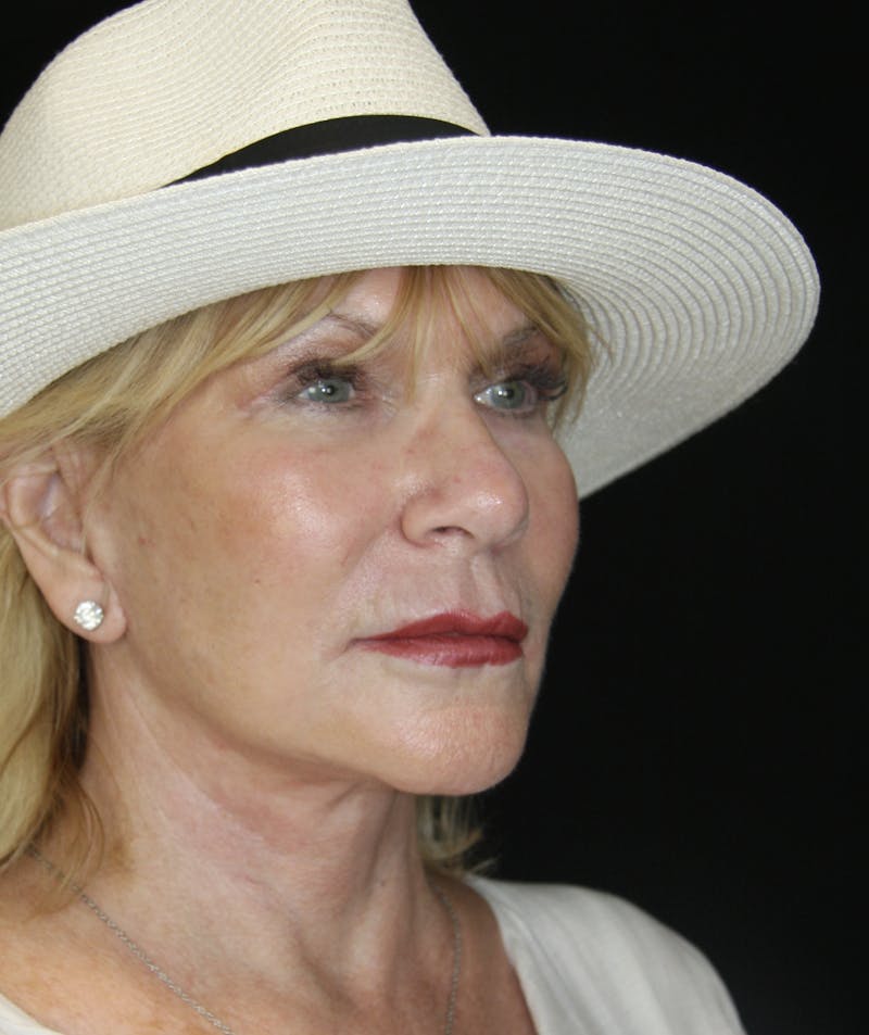 Facelift & Neck Lift Before & After Gallery - Patient 179412013 - Image 4