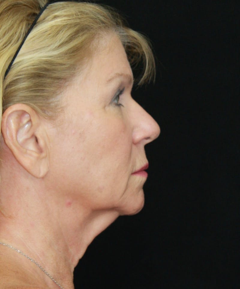 Facelift & Neck Lift Before & After Gallery - Patient 179412013 - Image 5