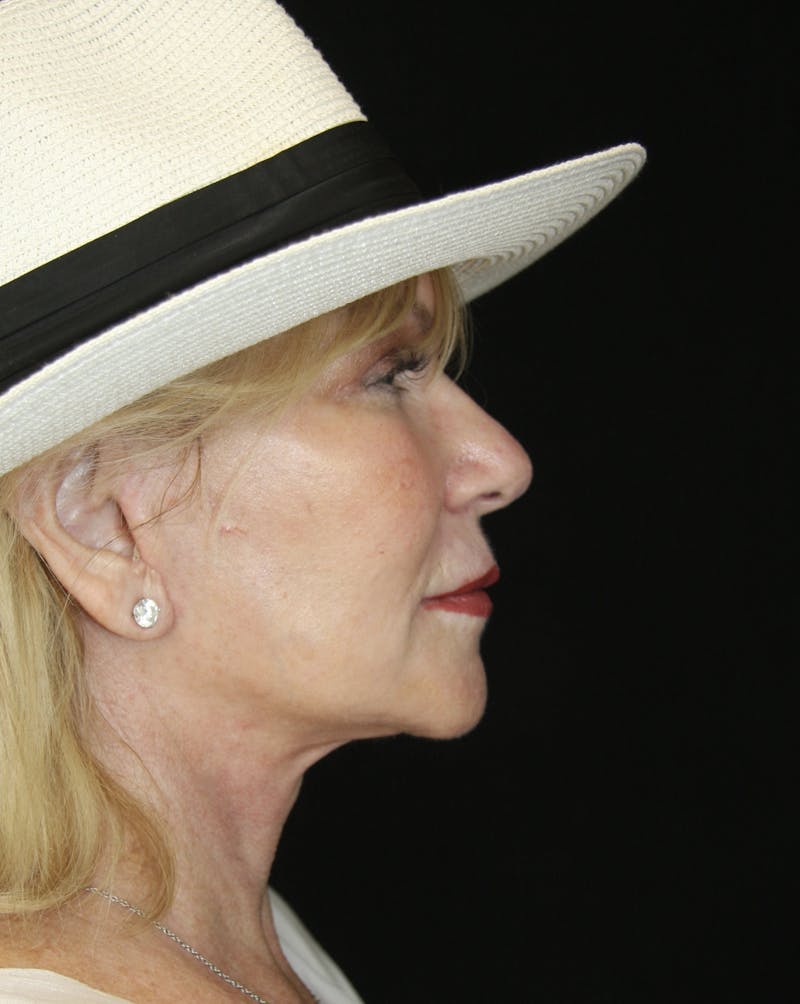 Facelift & Neck Lift Before & After Gallery - Patient 179412013 - Image 6