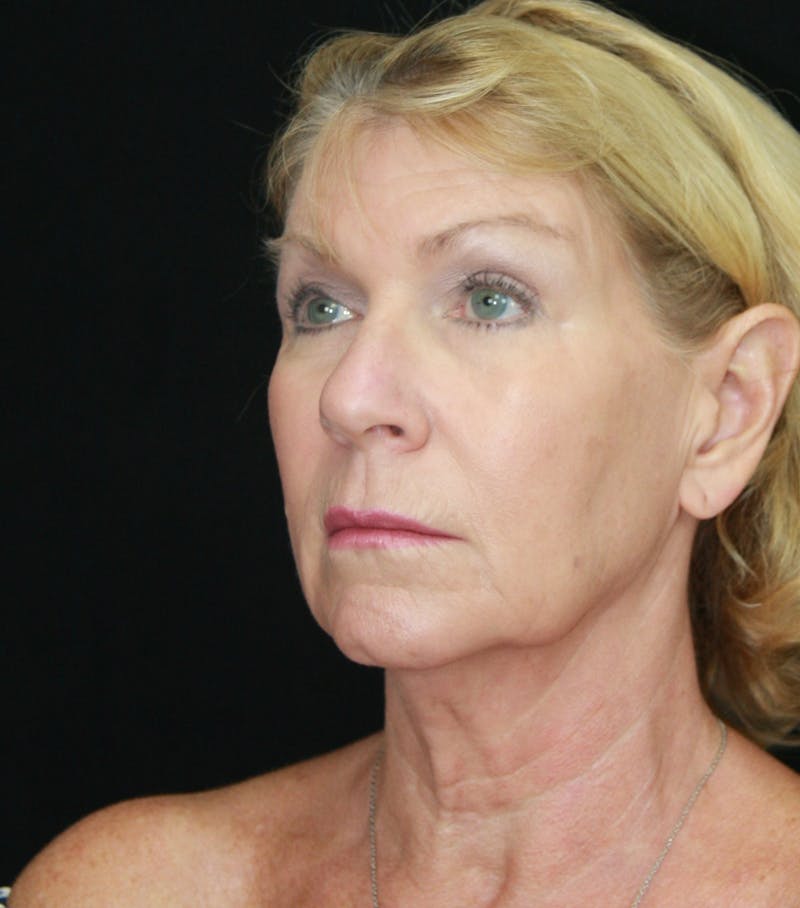 Facelift & Neck Lift Before & After Gallery - Patient 179412013 - Image 7