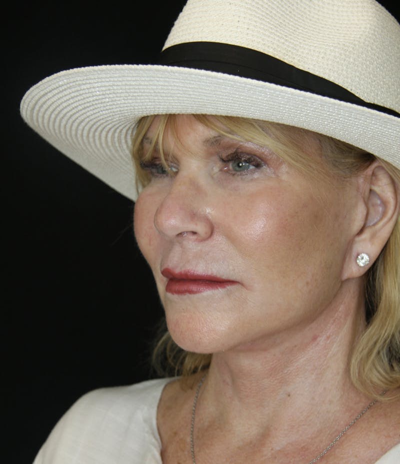 Facelift & Neck Lift Before & After Gallery - Patient 179412013 - Image 8