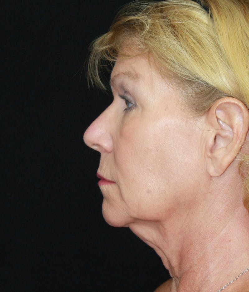 Facelift & Neck Lift Before & After Gallery - Patient 179412013 - Image 9