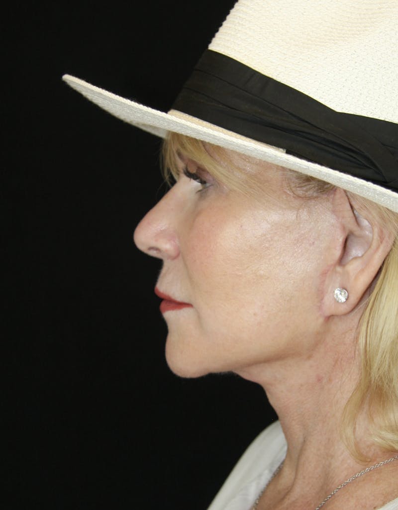 Facelift & Neck Lift Before & After Gallery - Patient 179412013 - Image 10