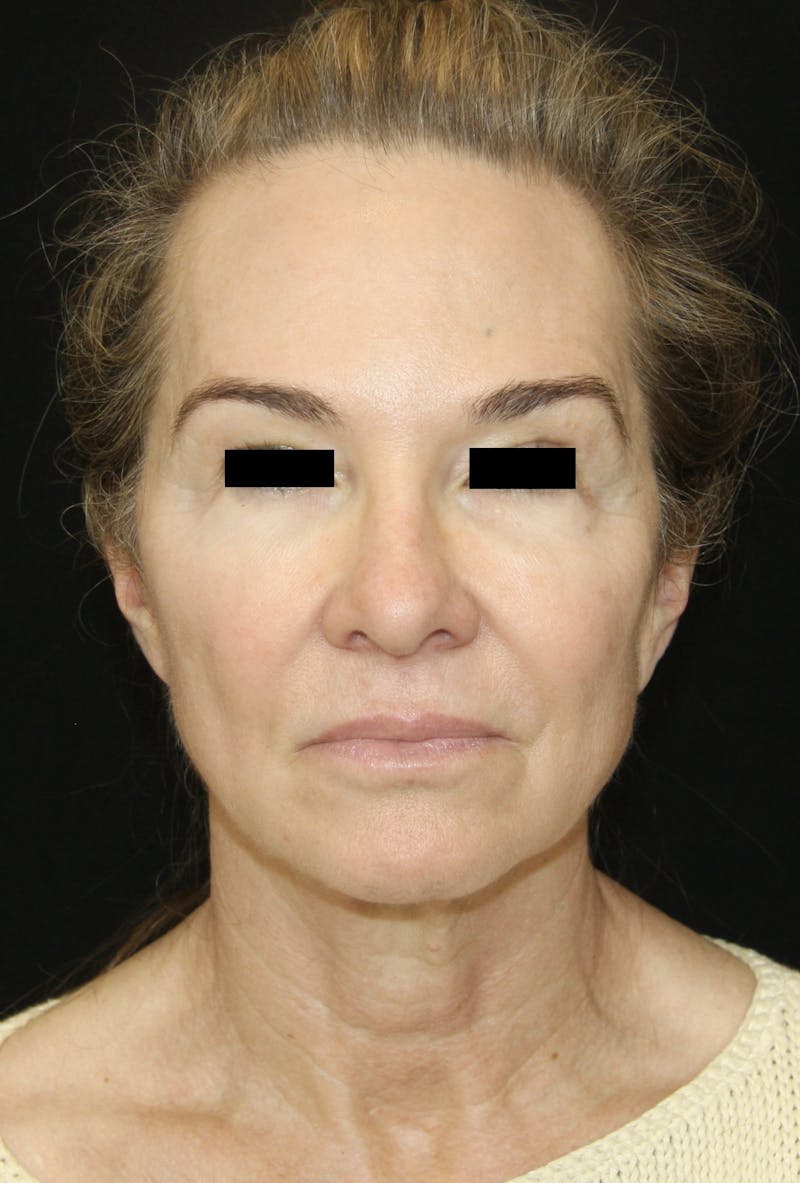Facelift & Neck Lift Before & After Gallery - Patient 179415992 - Image 1