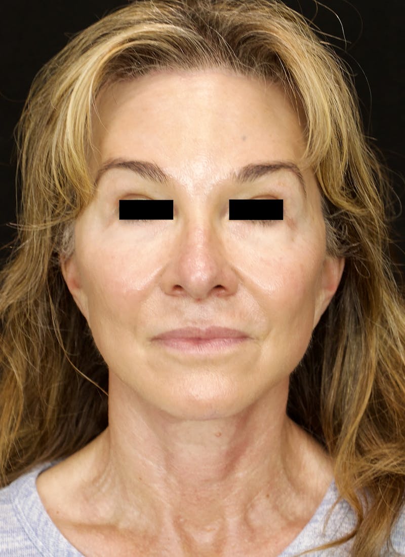 Facelift & Neck Lift Before & After Gallery - Patient 179415992 - Image 2