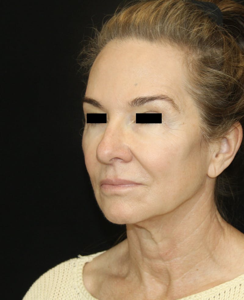 Facelift & Neck Lift Before & After Gallery - Patient 179415992 - Image 3