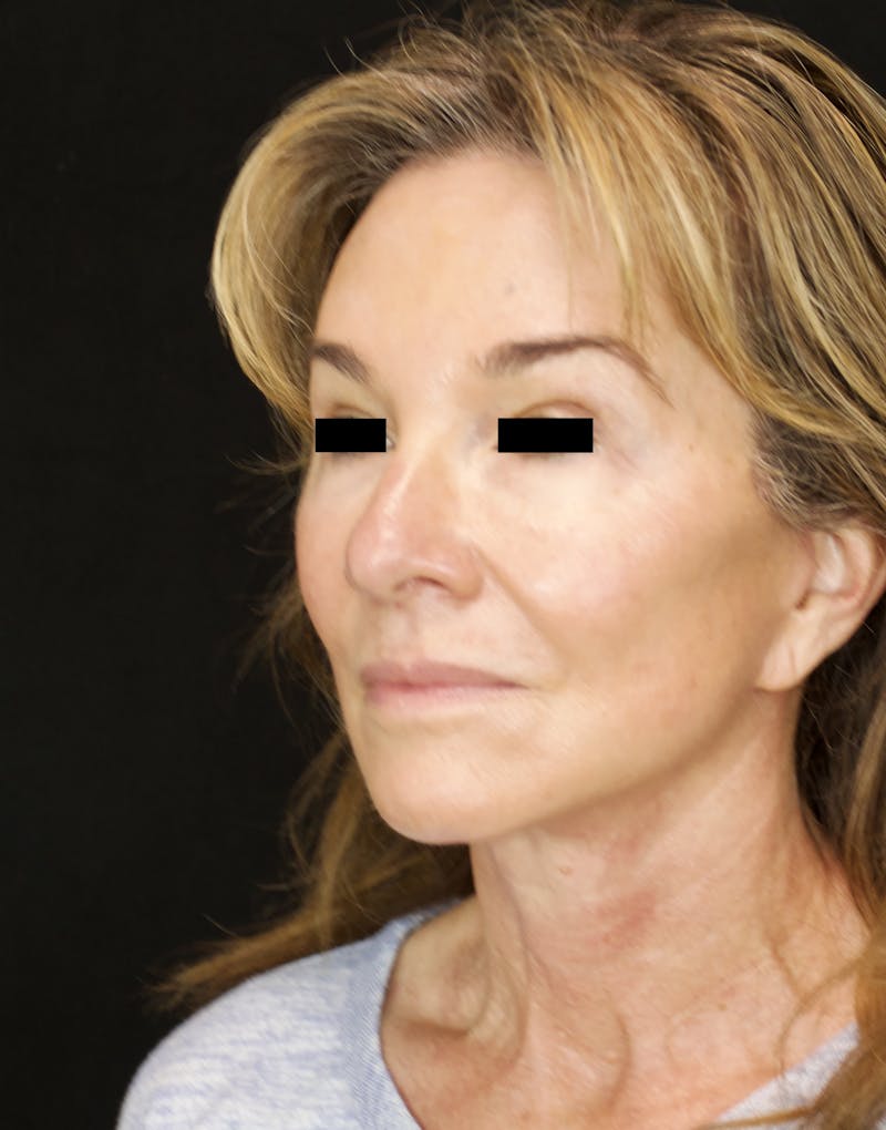Facelift & Neck Lift Before & After Gallery - Patient 179415992 - Image 4