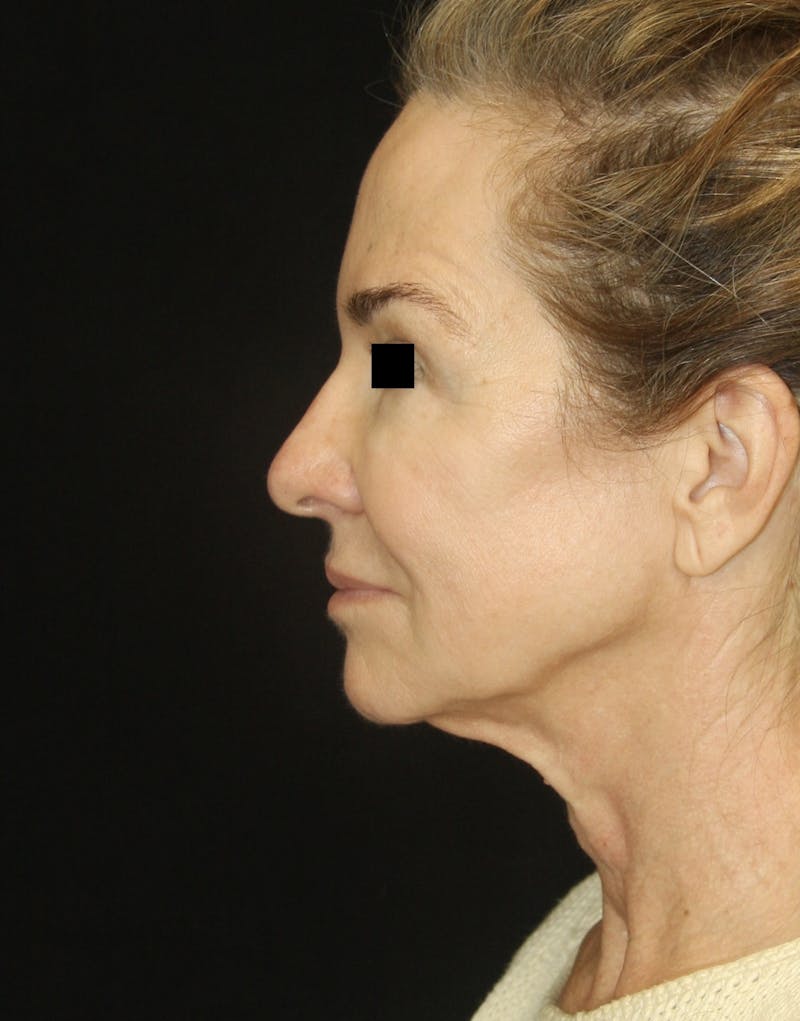 Facelift & Neck Lift Before & After Gallery - Patient 179415992 - Image 5