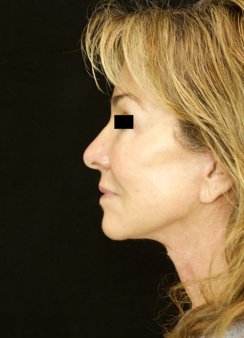 Facelift & Neck Lift Before & After Gallery - Patient 179415992 - Image 6