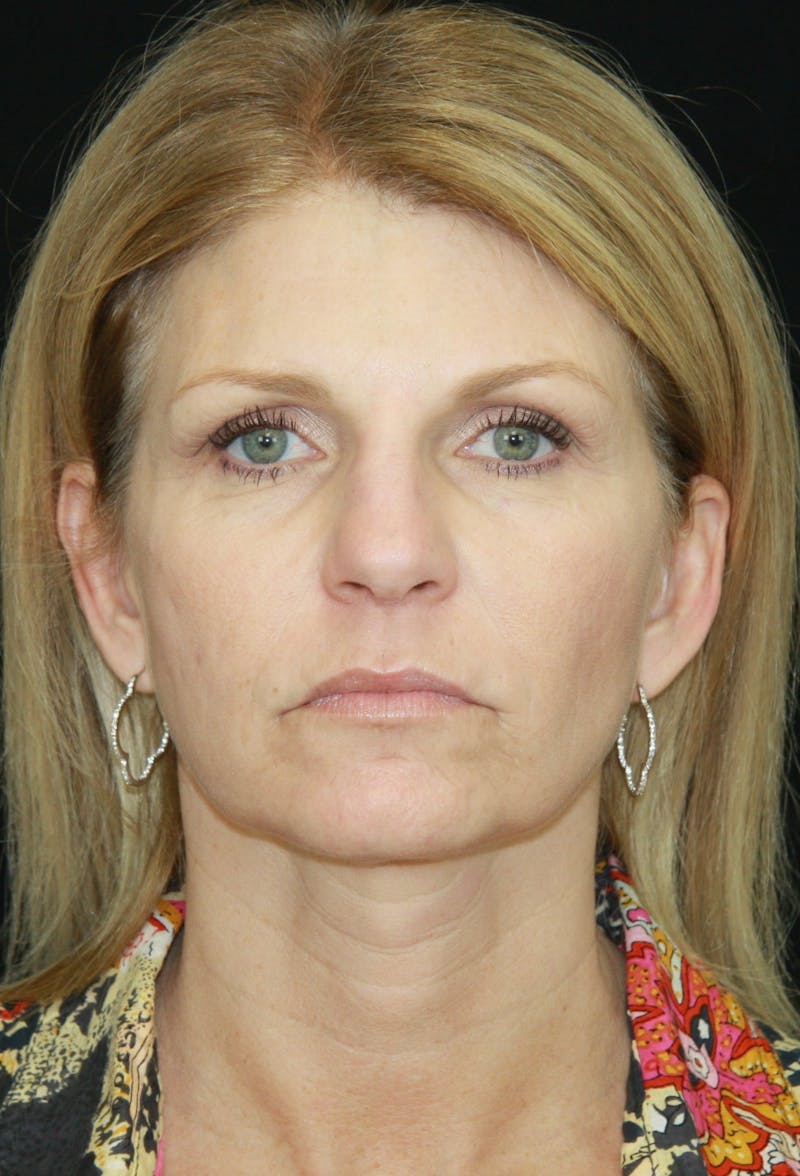 Facelift & Neck Lift Before & After Gallery - Patient 179418389 - Image 1