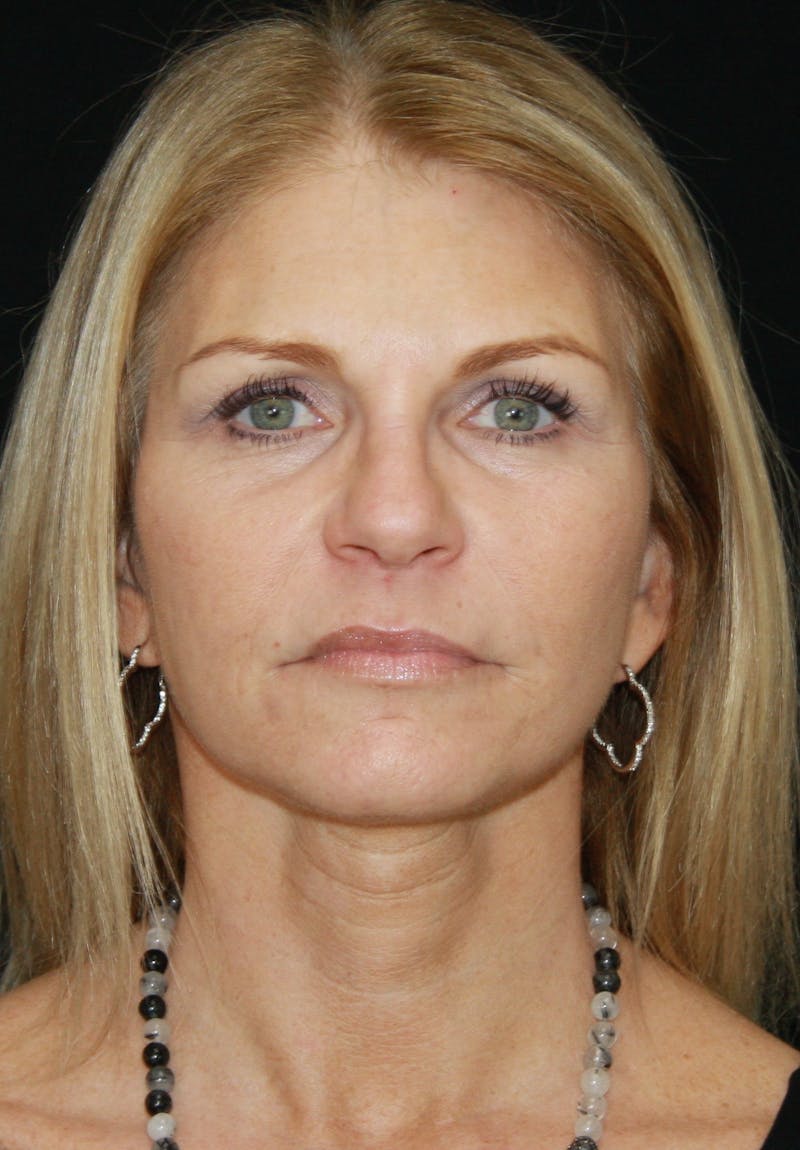 Facelift & Neck Lift Before & After Gallery - Patient 179418389 - Image 2
