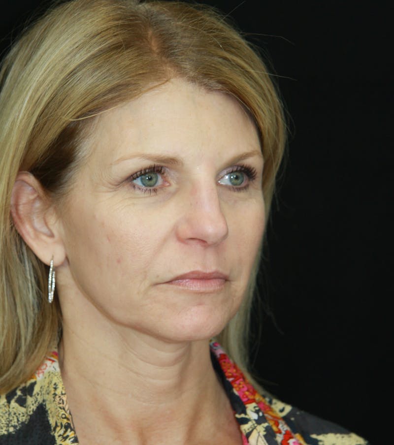 Facelift & Neck Lift Before & After Gallery - Patient 179418389 - Image 3
