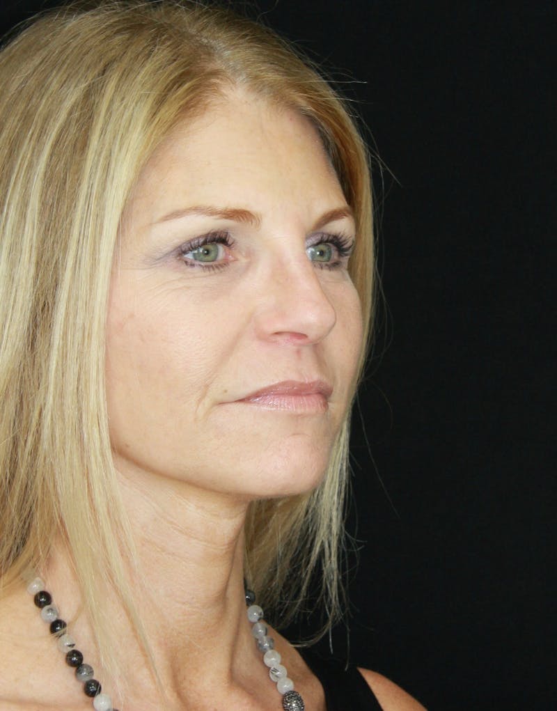 Facelift & Neck Lift Before & After Gallery - Patient 179418389 - Image 4