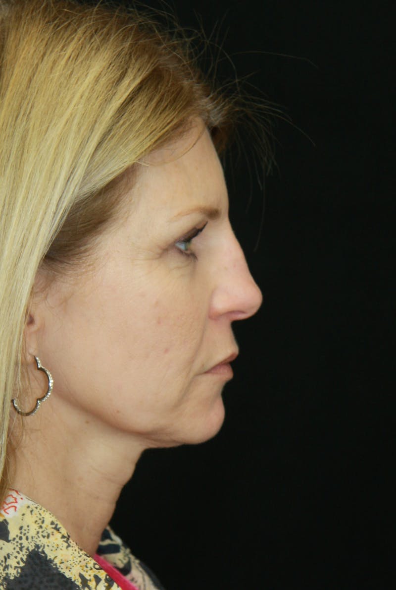 Facelift & Neck Lift Before & After Gallery - Patient 179418389 - Image 5