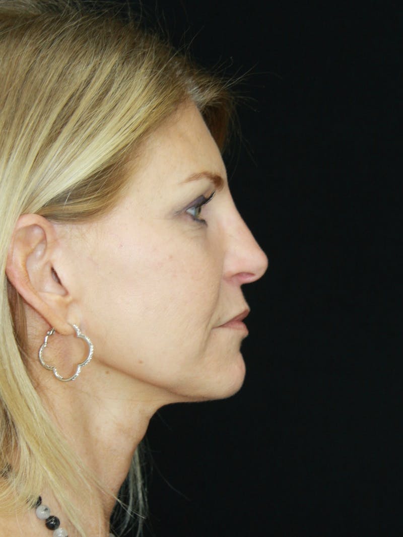 Facelift & Neck Lift Before & After Gallery - Patient 179418389 - Image 6