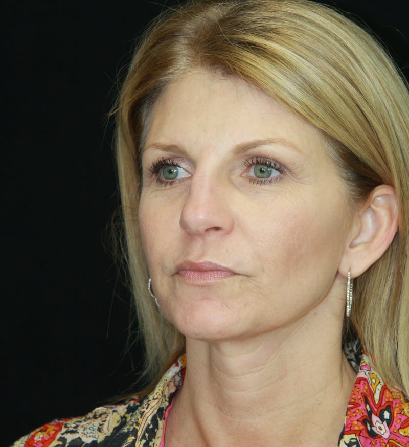 Facelift & Neck Lift Before & After Gallery - Patient 179418389 - Image 7
