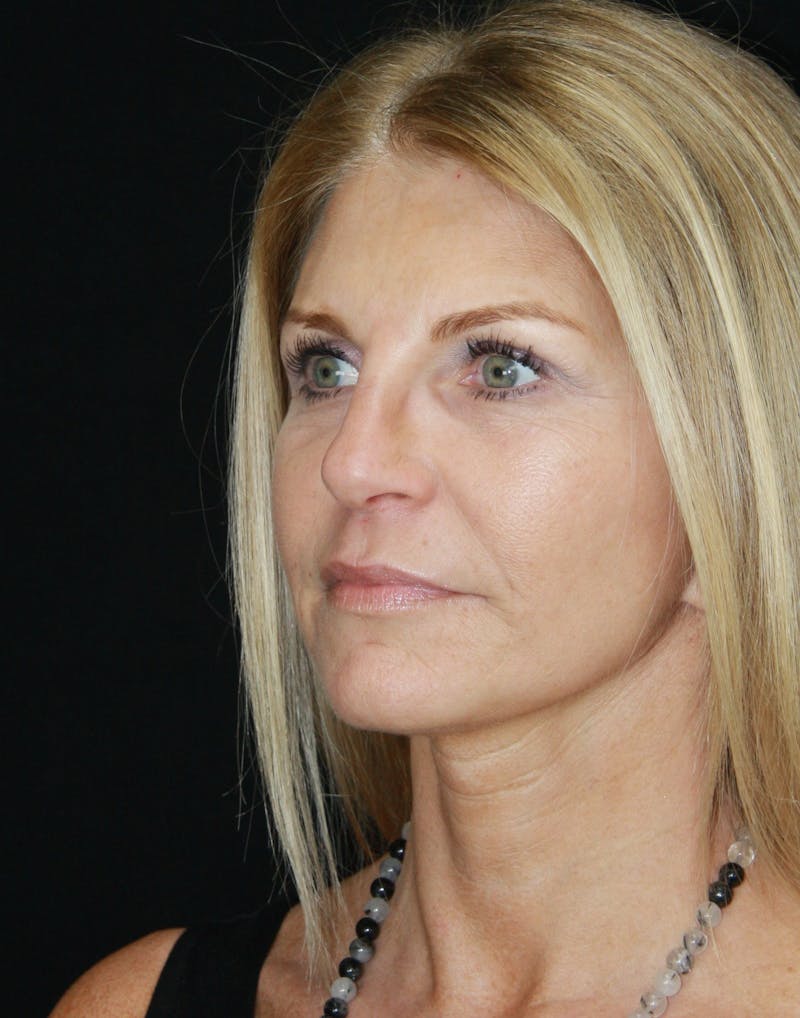 Facelift & Neck Lift Before & After Gallery - Patient 179418389 - Image 8