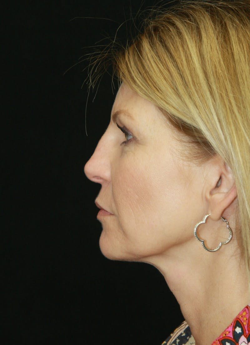 Facelift & Neck Lift Before & After Gallery - Patient 179418389 - Image 9