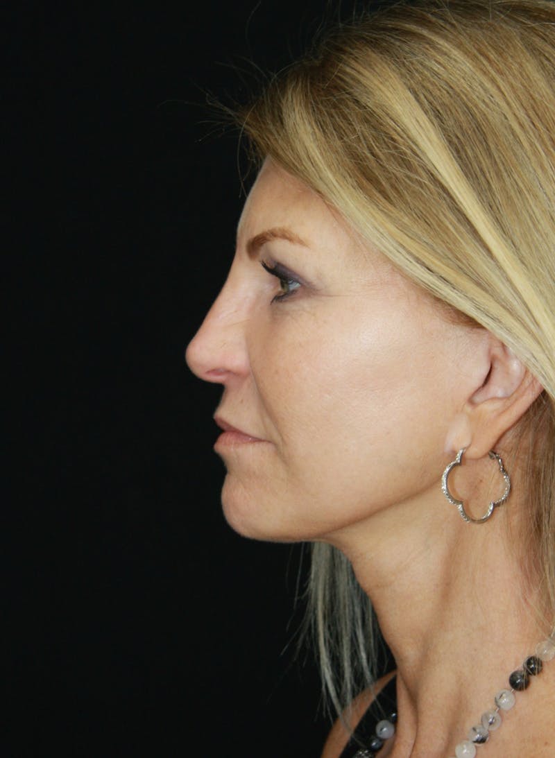 Facelift & Neck Lift Before & After Gallery - Patient 179418389 - Image 10