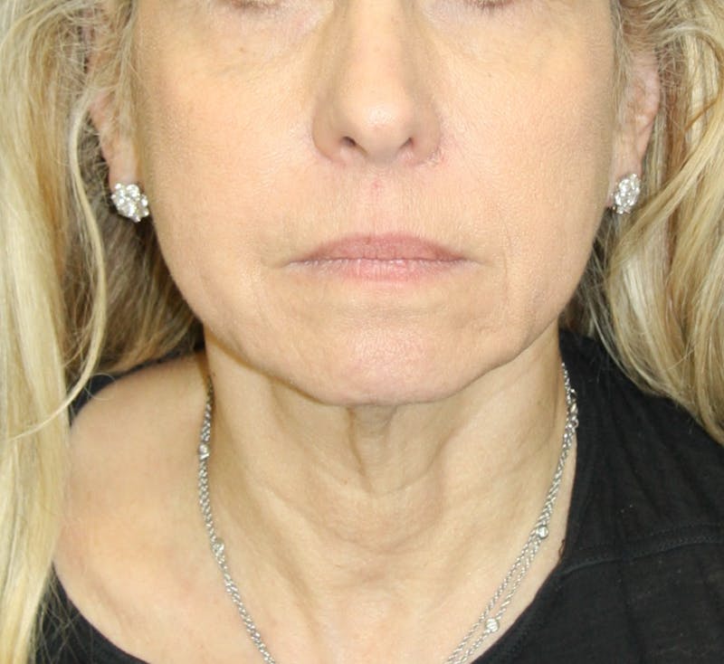 Facelift & Neck Lift Before & After Gallery - Patient 179437033 - Image 1