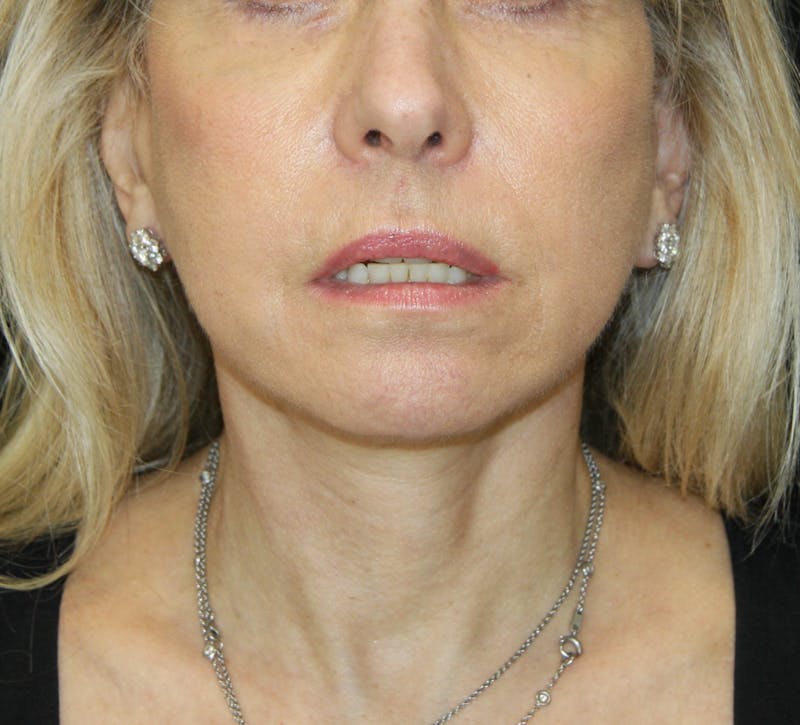 Facelift & Neck Lift Before & After Gallery - Patient 179437033 - Image 2