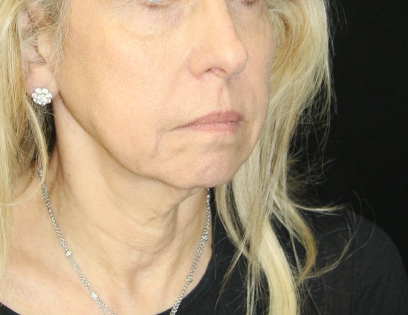 Facelift & Neck Lift Before & After Gallery - Patient 179437033 - Image 3
