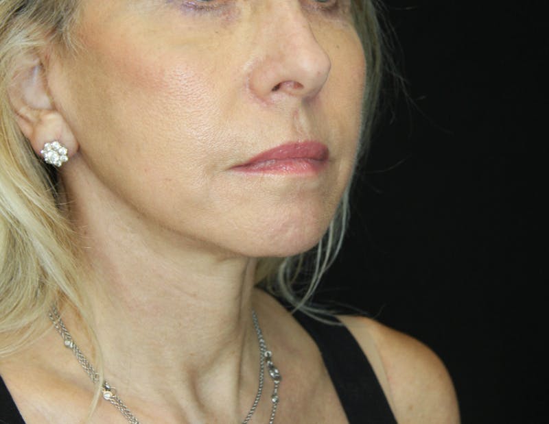 Facelift & Neck Lift Before & After Gallery - Patient 179437033 - Image 4