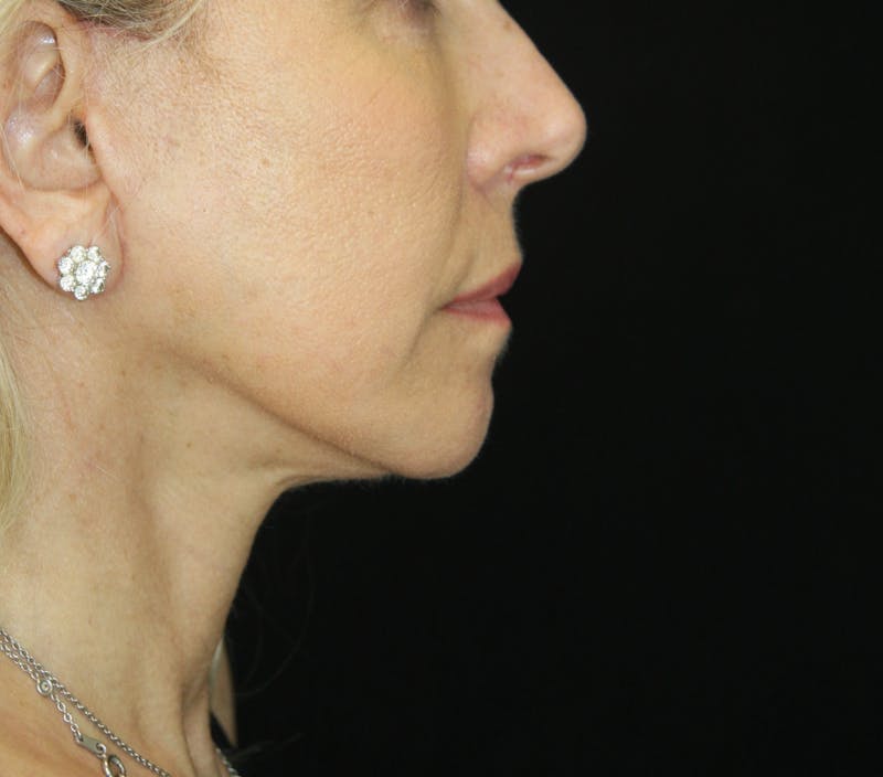 Facelift & Neck Lift Before & After Gallery - Patient 179437033 - Image 6