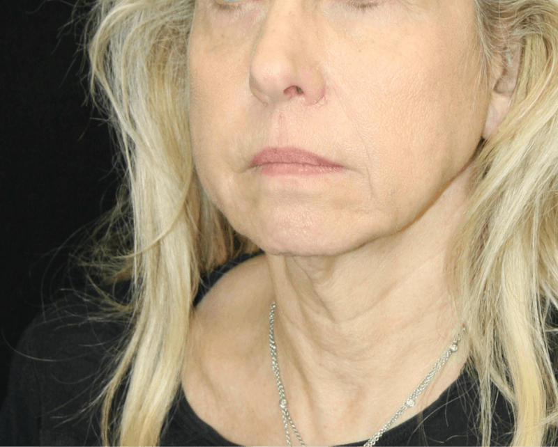 Facelift & Neck Lift Before & After Gallery - Patient 179437033 - Image 7