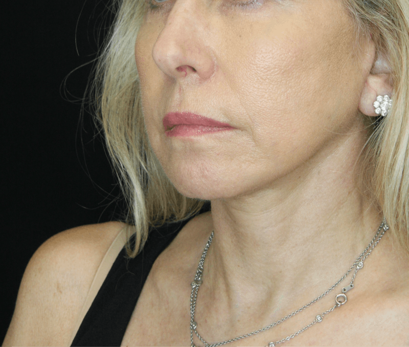 Facelift & Neck Lift Before & After Gallery - Patient 179437033 - Image 8
