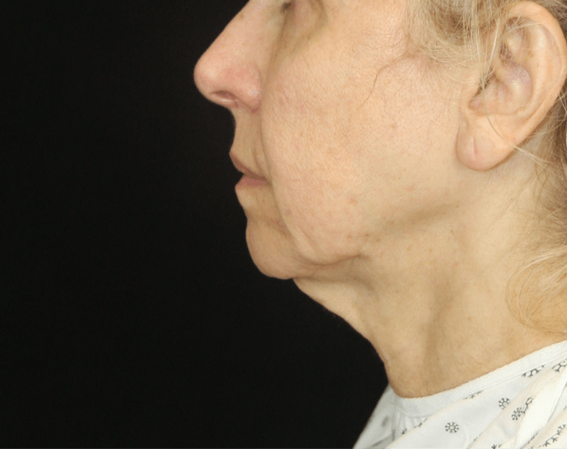 Facelift & Neck Lift Before & After Gallery - Patient 179437033 - Image 9